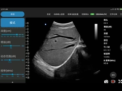 Cep Telefonu İçin Elektronik Dışbükey Dizi Kablosuz Ultrason Cihazı