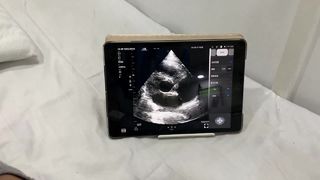 Kardiyak ve POCUS için Çift Kafalı Kablosuz Ultrason Probu