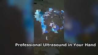 Modern Jinekoloji için Taşınabilir Transvajinal Ultrason
