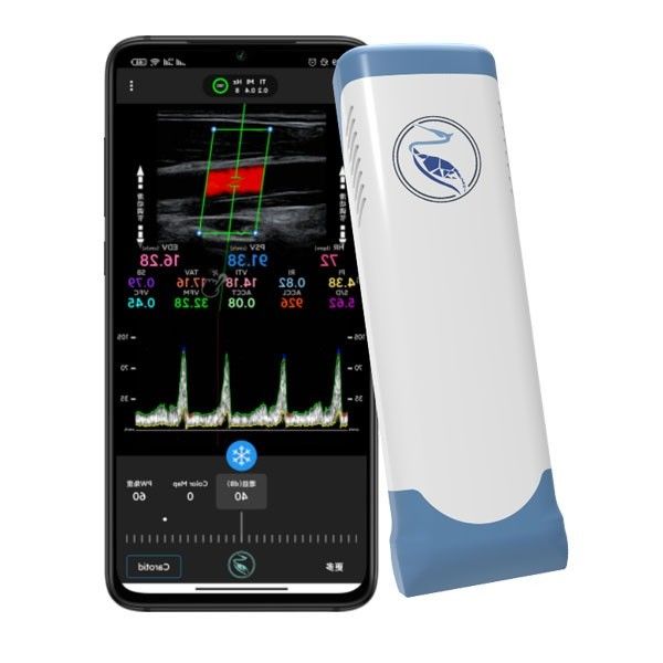 Yankı Renkli Doppler Kablosuz El Ultrason Tarayıcı 100 Çerçeve